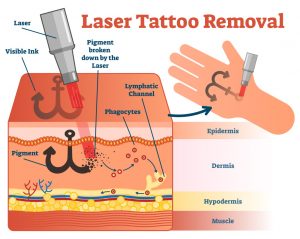 Laser tattoo removal schema