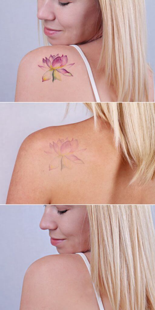 Removal of a color rose tattoo from the shoulder of a blonde woman