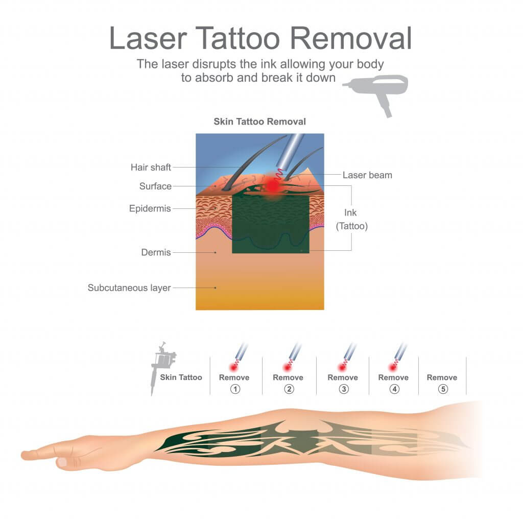 Laser tattoo removal explained